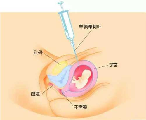 羊水穿刺后羊膜多久可以修復(fù)？羊穿后多久可以把膠布撕了？