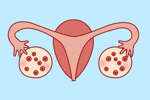 多囊卵巢與熬夜有關嗎？雙卵巢多囊綜合癥要多少錢調理？