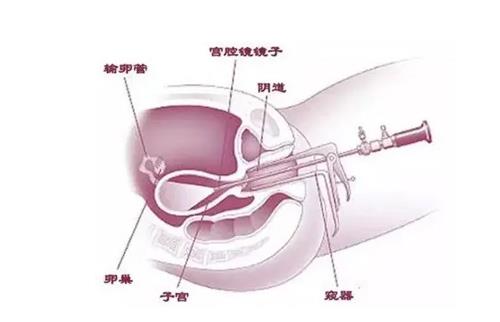 試管嬰兒都要宮腔鏡嗎?試管嬰兒檢查宮腔鏡是什么原因呢?